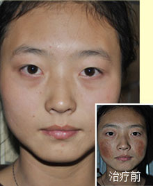 32岁的美容师被激素依赖性皮炎赖上了，在北京星光门诊部赵桂荣大夫这里得到恢复
